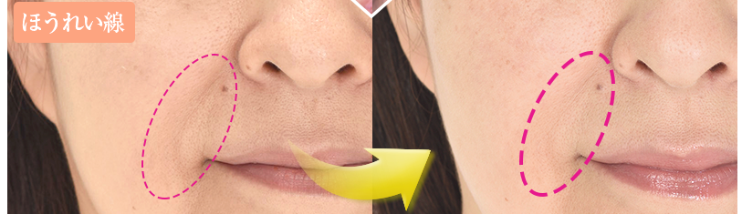 簡単に顔のシワを伸ばす方法